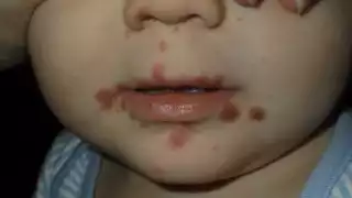 IMSS registra casos del virus coaxsackie en niños de dos a 10 años en Sinanché