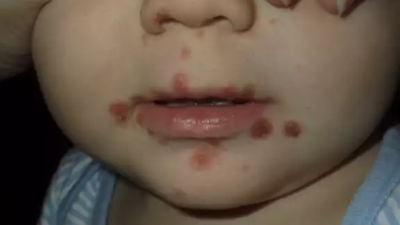 El médico recomendó a padres de familia estar pendientes de sus hijos para prevenir que sean infectados El médico recomendó a padres de familia estar pendientes de sus hijos para prevenir que sean infectados