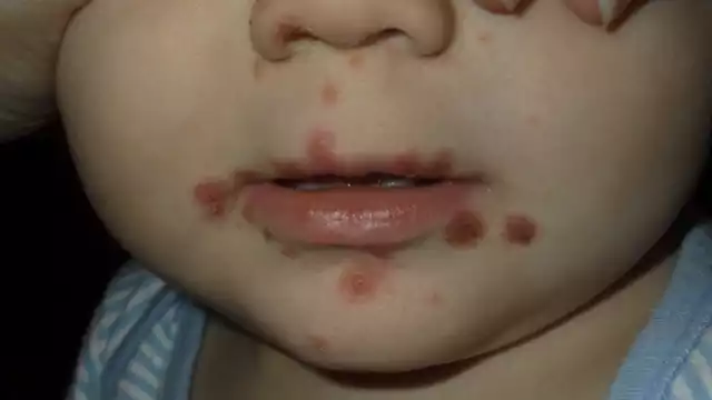 El médico recomendó a padres de familia estar pendientes de sus hijos para prevenir que sean infectados