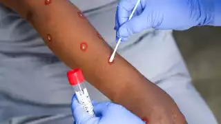 En el país se identificaron 66 casos probables y nueve confirmados de la enfermedad