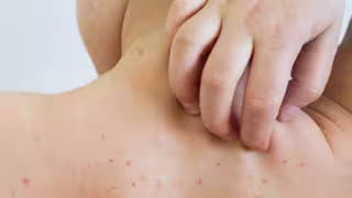 México lidera casos de sarampión en América: contagios se disparan y alertan por baja vacunación