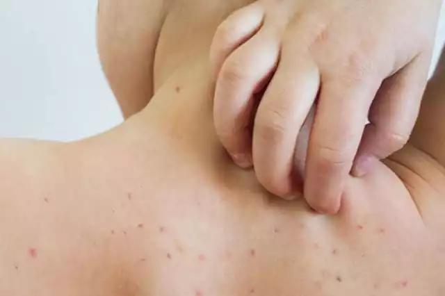 91.1 por ciento de los casos confirmados en México corresponden a personas sin antecedente de vacunación