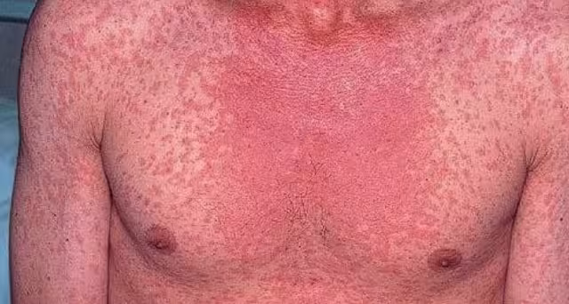 El sarampión puede causar la muerte por complicaciones graves, no solo por la erupción o la fiebre.