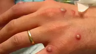 México confirma el primer caso de viruela del mono en el país