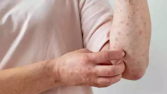 La viruela del mono se ha extendido en todo el mundo