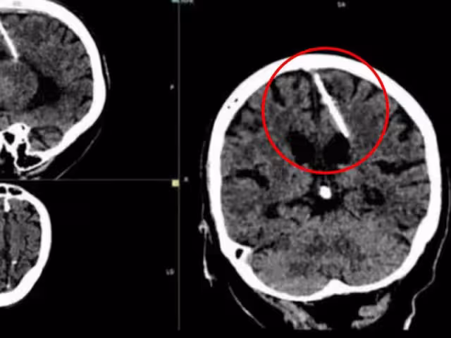 Los médicos aseguran que sus papás intentaron matarla cuando era bebé