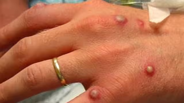 Un hombre de 40 años y una joven de 23 son los posibles casos de viruela del mono en Jalisco