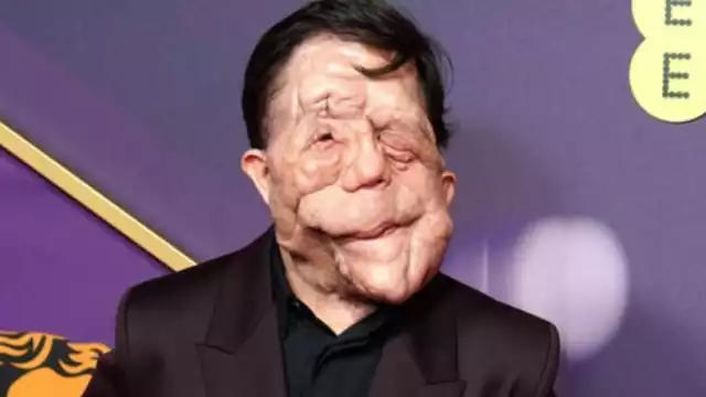 Adam Pearson asistió a los BAFTA por su papel en 'A Different Man'