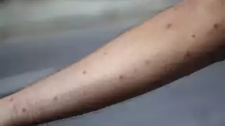 Secretaría de Salud confirma nuevo caso de Mpox en Yucatán