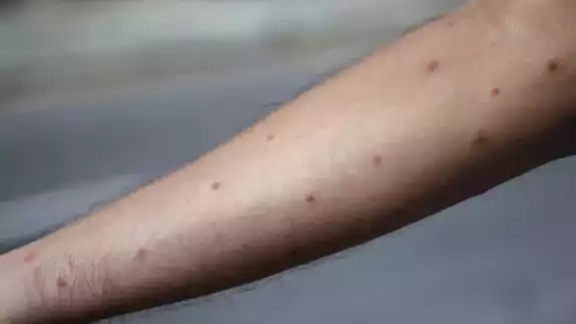El mpox se ha registrado en Yucatán este 2025 El mpox se ha registrado en Yucatán este 2025