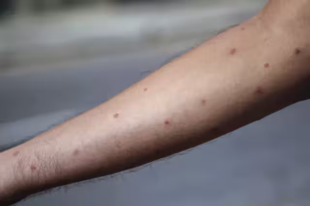 El mpox se ha registrado en Yucatán este 2025