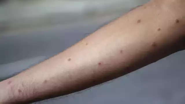 El mpox se ha registrado en Yucatán este 2025