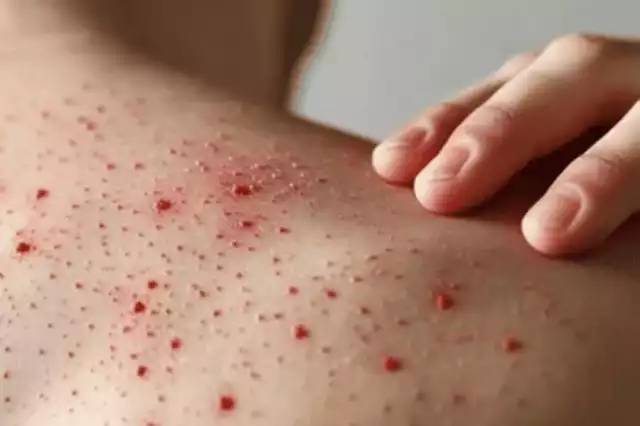 El sarampión es una enfermedad viral altamente contagiosa, prevenible mediante esquemas completos de vacunación