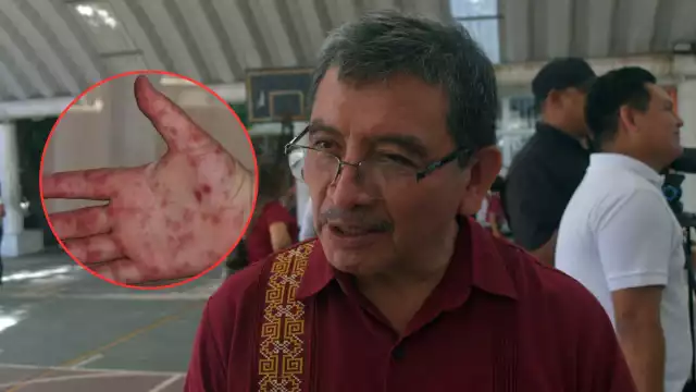 Suspenden clases en comunidades de Calkiní por brote de Coxsackie; 30 niños contagiados