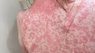 Sarampión en Quintana Roo:  Reportan 11 nuevos contagios en 24 horas