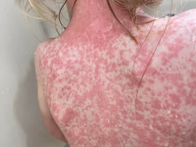 Quintana Roo escaló al lugar 13 a nivel nacional en esta enfermedad, además de incrementar de 2.7 a 3.2 la tasa de incidencia por cada 100 mil habitantes