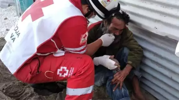 El hombre fue atacado con ácido en el cuerpo El hombre fue atacado con ácido en el cuerpo