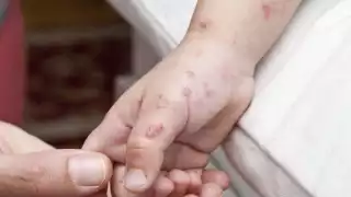 12 menores de edad de un preescolar de Seybaplaya han sido afectados por el virus Coxsackie