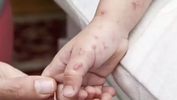12 menores de edad de un preescolar de Seybaplaya han sido afectados por el virus Coxsackie 12 menores de edad de un preescolar de Seybaplaya han sido afectados por el virus Coxsackie