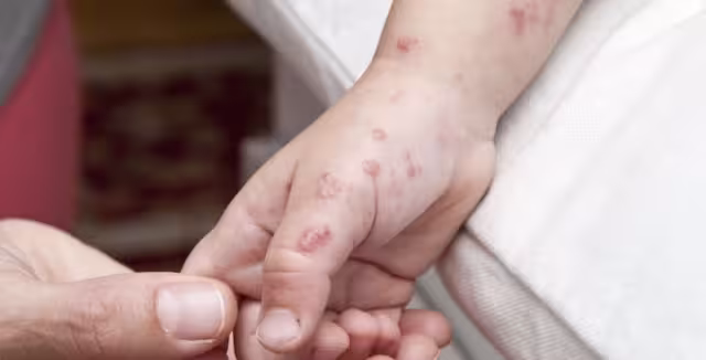 12 menores de edad de un preescolar de Seybaplaya han sido afectados por el virus Coxsackie