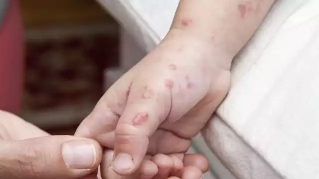 12 menores de edad de un preescolar de Seybaplaya han sido afectados por el virus Coxsackie