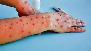 Exhortan a la población que en caso de presentar síntomas acudir a un Centro de Salud.