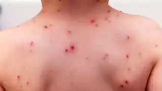 En menos de tres meses suman 132 contagios; en 2024 se registraron solo 84 en todo el año