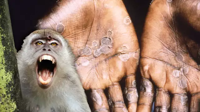 Así lograrás identificar la denominada viruela del mono