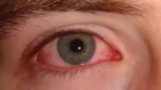 Se inflama la conjuntiva, la membrana transparente que recubre el interior del párpado, así como la parte blanca del ojo