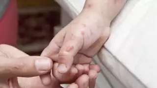 Dos menores carmelitas contagiados del virus Coxsackie