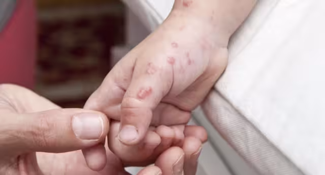 Dos menores afectados por Coxsackie en primaria de Campeche