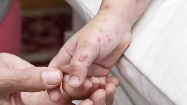 Dos menores afectados por Coxsackie en primaria de Campeche