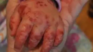  Padres de familia denuncian presunto brote de Coxsackie en una guardería de Campeche   