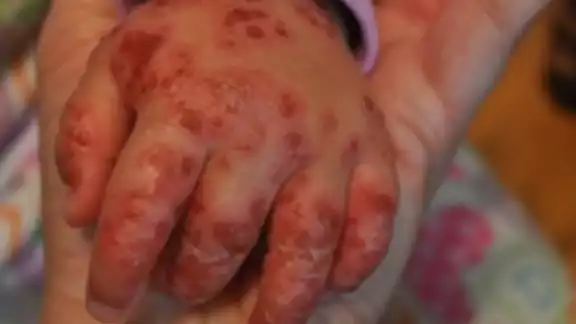El virus hace que broten ronchitas y salpullido en la piel del enfermo, que se transmiten por contacto directo El virus hace que broten ronchitas y salpullido en la piel del enfermo, que se transmiten por contacto directo