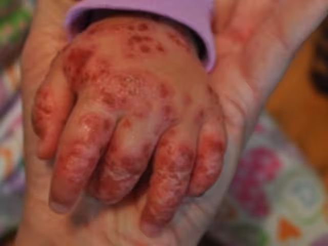 El virus hace que broten ronchitas y salpullido en la piel del enfermo, que se transmiten por contacto directo