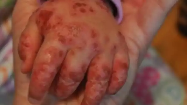 El virus hace que broten ronchitas y salpullido en la piel del enfermo, que se transmiten por contacto directo