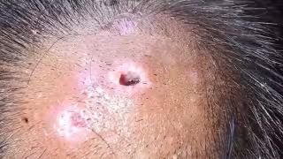 Detectan dos casos nuevos de gusano barrenador en humanos en Quintana Roo