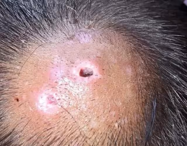 Según informes, se hallaron larvas en cabeza, oído, cuello y piernas