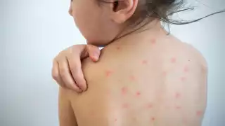 Con medidas preventivas se reduce la posibilidad de contagiarse