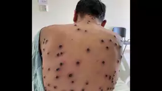 La Secretaría de Salud informó que en México se han registrado 212 casos de Mpox