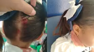 La lesión de la menor requirió seria atención médica