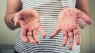 El sarampión se transmite por gotículas respiratorias y contacto cercano con personas infectadas