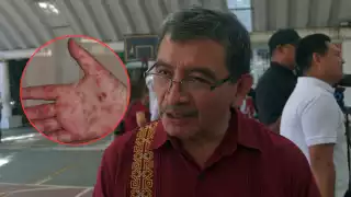 Suspenden clases en comunidades de Calkiní por brote de Coxsackie; 30 niños contagiados