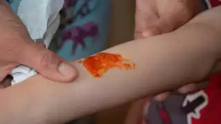 Alerta en Cancún por aumento de mordeduras de animales