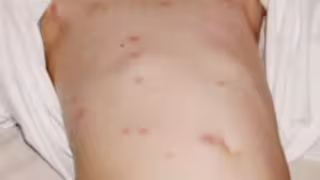 Estado concentra casos de mpox, varicela y leishmaniasis