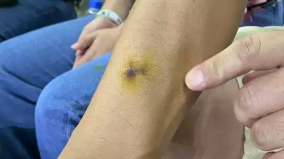 El aficionado y su brazo ligeramente afectado El aficionado y su brazo ligeramente afectado