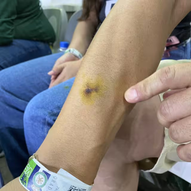 El aficionado y su brazo ligeramente afectado