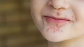 Tankuché logra frenar contagios de coxsackie tras pico de 40 casos