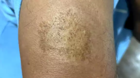 Los que son más propensos a la picadura de la mosca chiclera son leñadores o gente que va a la milpa a hacer actividades agrícolas Los que son más propensos a la picadura de la mosca chiclera son leñadores o gente que va a la milpa a hacer actividades agrícolas