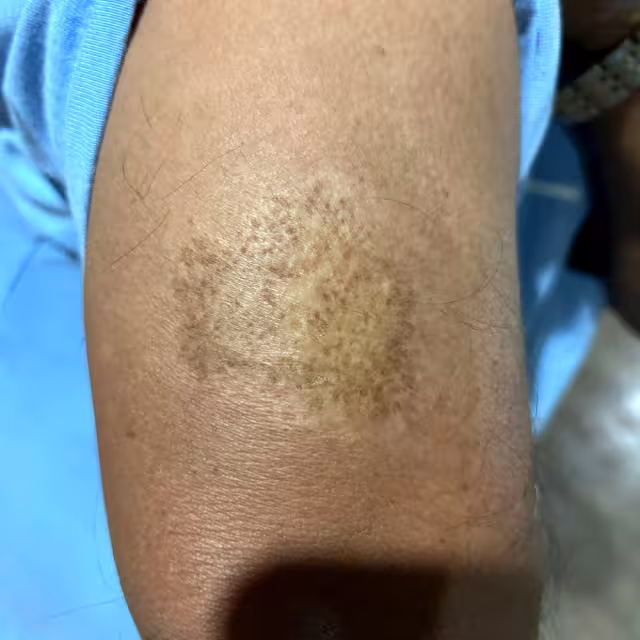 Los que son más propensos a la picadura de la mosca chiclera son leñadores o gente que va a la milpa a hacer actividades agrícolas